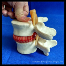 Vergrößern Demonstration Lumbal Disc Herniation Model